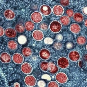 美国猴痘确诊超4600例 成本次疫情病例数最多的国家